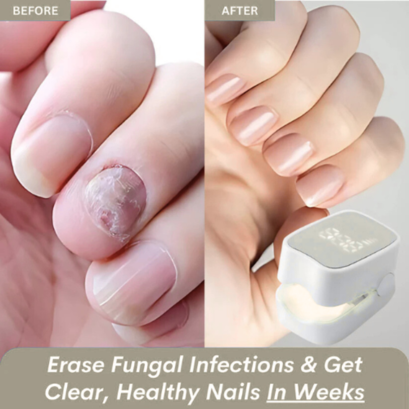 Drova™ - Nail Fungus Laser Device