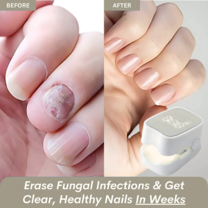 Drova™ - Nail Fungus Laser Device