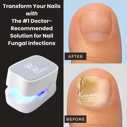Drova™ - Nail Fungus Laser Device
